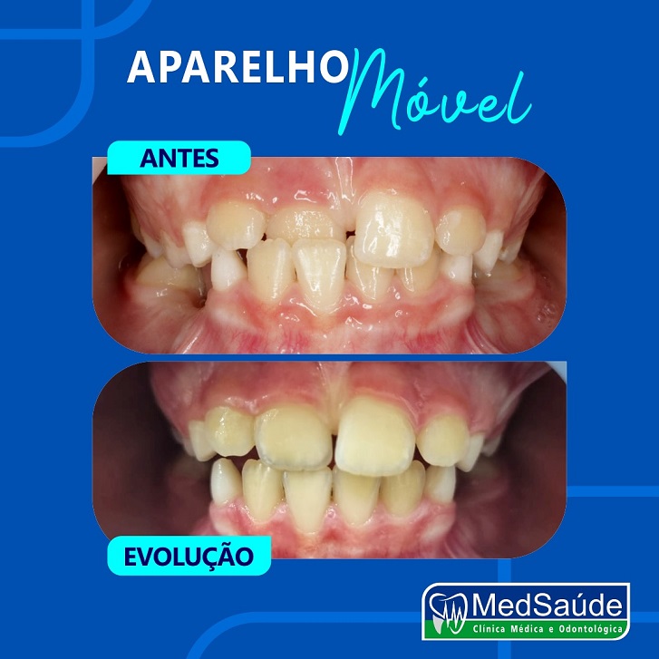 aparelho dentário