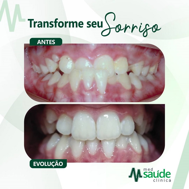 aparelho dentário